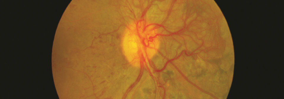 Bei der diabetischen Retinopathie kommt es zu kleinen Hämorrhagien und einer Sauerstoff­unterversorgung des Gewebes.
