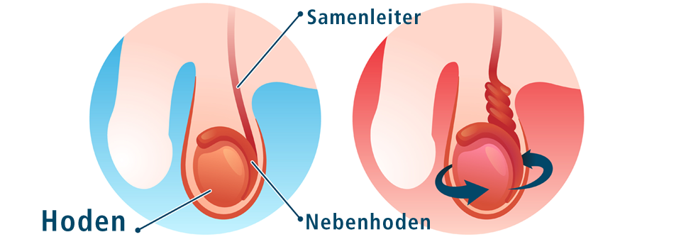 Der Farbdoppler ist ein gutes diagnostisches Tool für eine Hodentorsion.