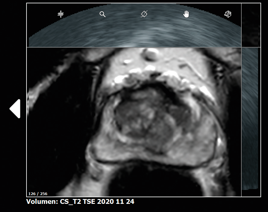 Abb. 2–4: Der Urologe erstellt aus der MRT ein 3D-Modell der Prostata inklusive der suspekten Areale (in gelb markiert). Über eine transrektale Sonographie kann er dann stereotaktisch transversal sowie sagittal biopsieren (Biopsiekanäle in grün) und die entsprechend abgeklärten Orte im Modell speichern.