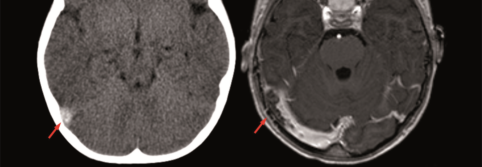 CT ohne und MRT mit Kontrastmittel zeigen beide den Befund einer SVT (Pfeil) beim selben Patienten.

