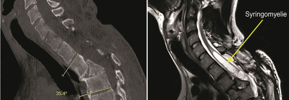 Dieser 24-Jährigen erlitt durch einen Verkehrsunfall eine vollständige thorakale Querschnittslähmung. Die Fraktur wurde initial operativ stabilisiert, ohne Kyphose und Spinalstenose zu versorgen. Der junge Mann entwickelte im Verlauf progrediente neurologische Störungen an den Händen. Im MRT rechts zeigte sich als Ursache eine Syringomyelie, die sich auf Frakturhöhe ausgebildet und nach kranial ausgedehnt hatte.