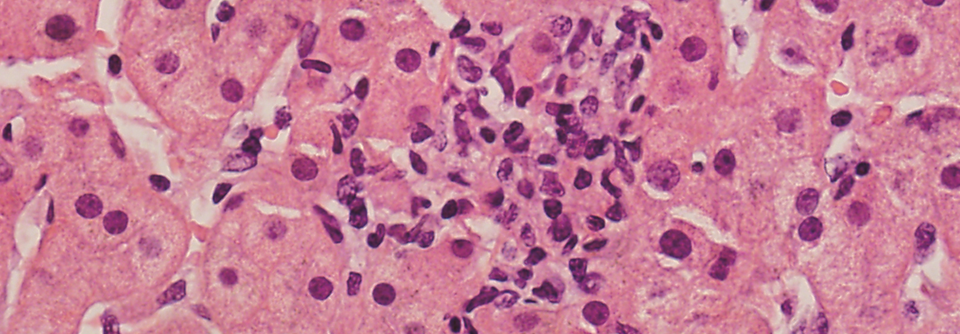 Herde von nekrotischen Hepatozyten und isolierte Granulome bei DILI.
