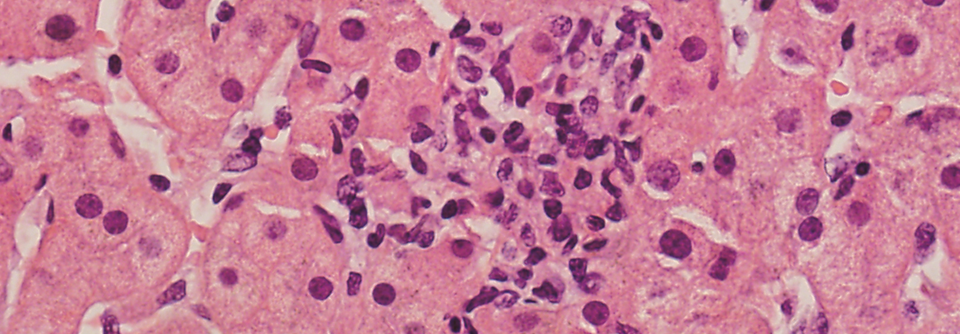 Herde von nekrotischen Hepatozyten und isolierte Granulome bei DILI.
