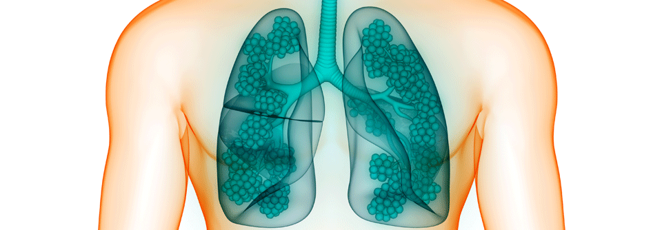 In jedem Fall gilt es, den Lungenumbau so gut wie möglich aufzuhalten.