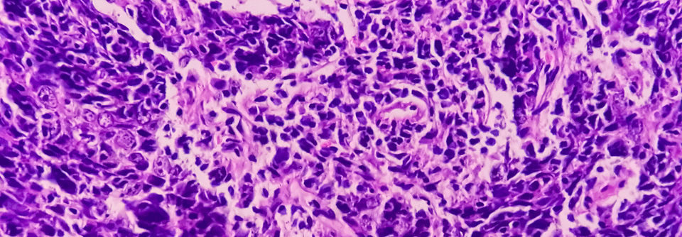 Tumoren des Nasopharynx werden unterteilt in Plattenepithel-, nicht-keratinisierende und undifferenzierte Karzinome.