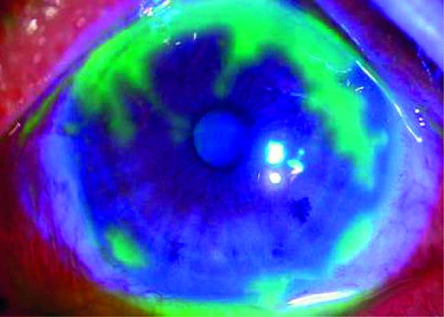 Wenn Herpesviren das Auge befallen, dann meist in Form einer Keratokonjunktivitis.
