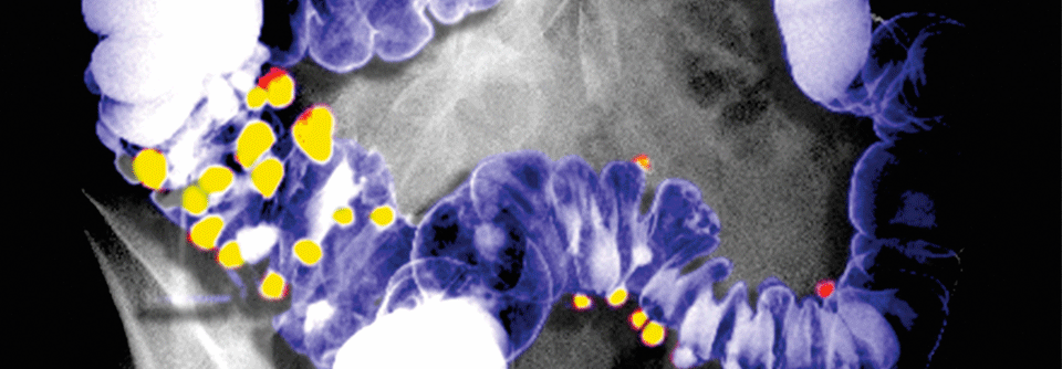 Beim Kolonkontrasteinlauf werden im Röntgenbild neben schattengebenden Konturen auch Divertikel sichtbar (gelb).