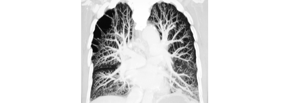 Je nach Grunderkrankung steht das arterielle Gefäßsystem der Lunge unter gehörigem Druck.
