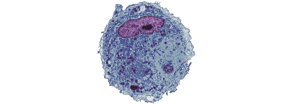 Auf Lungenkrebszellen wie dieser hat 
man  mittlerweile molekulare Zielstruk­turen identifiziert, die therapeutisch angegangen werden können.
