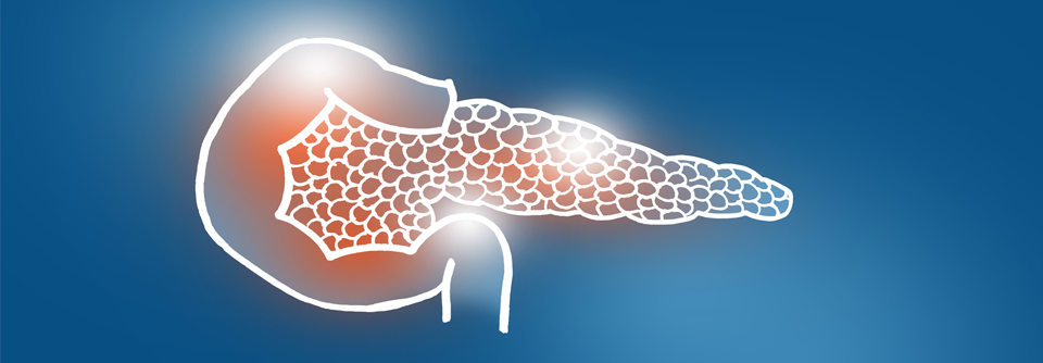 Ein Diabetes auf Basis einer ex­okrinen Pankreasfunktionsstörung verläuft deutlich ungünstiger als ein klassischer Typ-2-Diabetes.