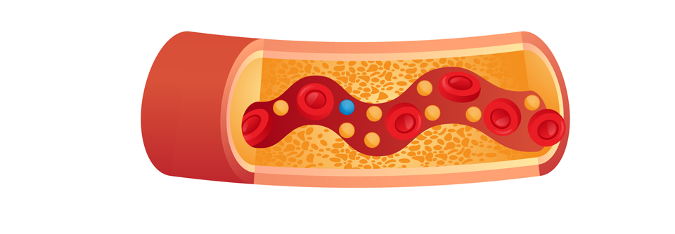 Die leitliniengerechte Senkung des LDL-Cholesterins führt zu einem reduzierten kardiovaskulären Risiko.