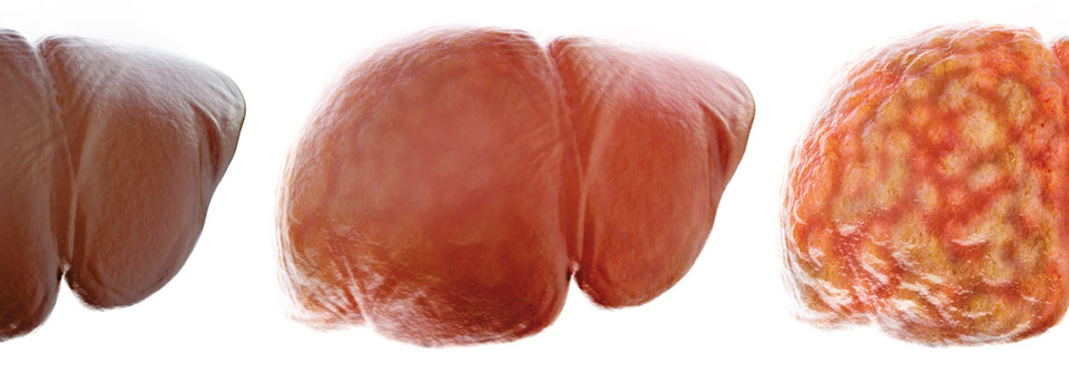 Etwa ein Drittel der Erwachsenen weist eine Fettleber auf, aus der sich u.a. eine Zirrhose entwickeln kann.