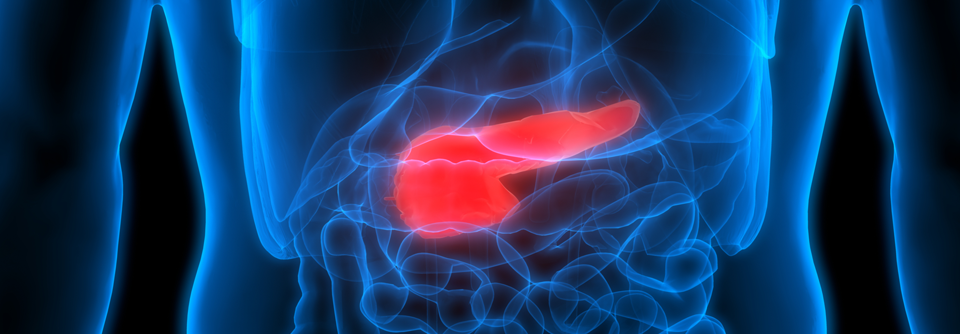 Hyperglykämie und Inflammation können die Entwicklung eines duktalen Pankreasadenokarzinom fördern.
