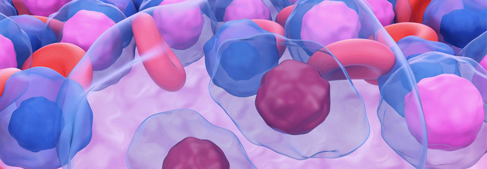 Charakteristisch für das klassische Hodgkin-Lymphom: maligne Hodgkin-Reed-Sternberg-Zellen. Diese sind mehrkernig.