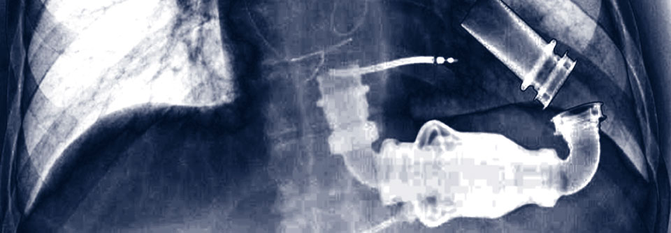 Diese Thoraxaufnahme zeigt das implantierte LVAD einer 65-jährigen Patientin mit Herzinsuffizienz.