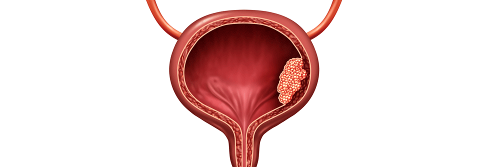 Urothelkarzinom: Langzeitdaten belegen Effektivität von Avelumab Langzeitdaten der JAVELIN-Bladder-100-Studie bestätigen die Wirksamkeit von Avelumab beim Urothelkarzinom.