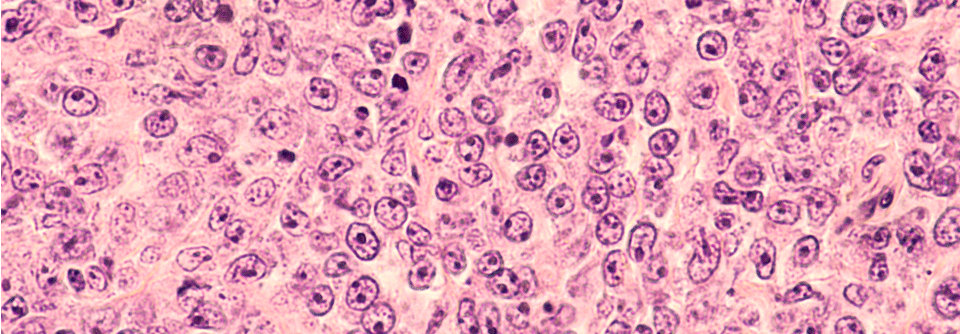 Der Internationale Prognostische Index zur Evaluierung der Prognose beim DLBCL könnte in absehbarer Zeit vom Internationale Metabolische Prognostische Index abgelöst werden.