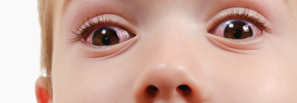 Eine übersehene Uveitis kann bei Kindern schwere Komplikationen nach sich ziehen.