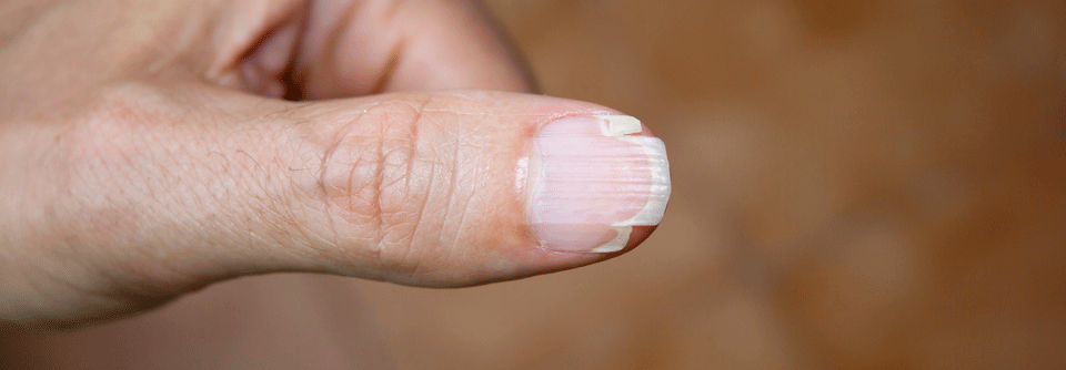 Die Split Nails treten zumeist an den Daumen auf.