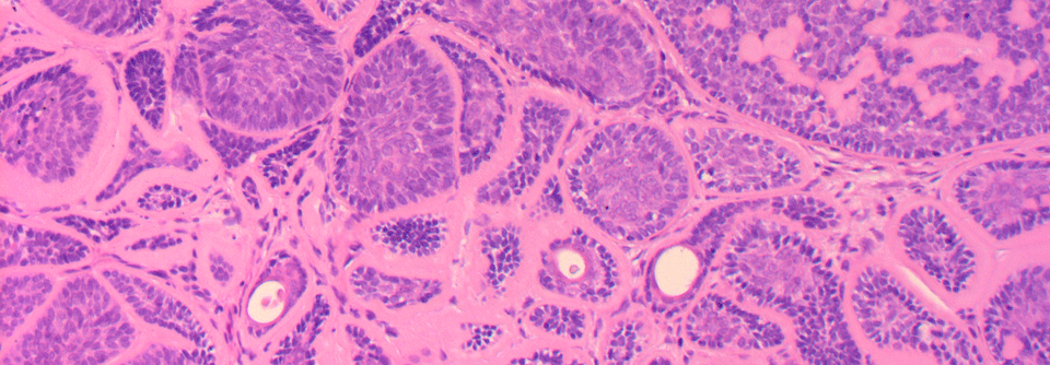 Zylinderartige Zellen im histologischen Bild sind für den Tumor namensgebend.