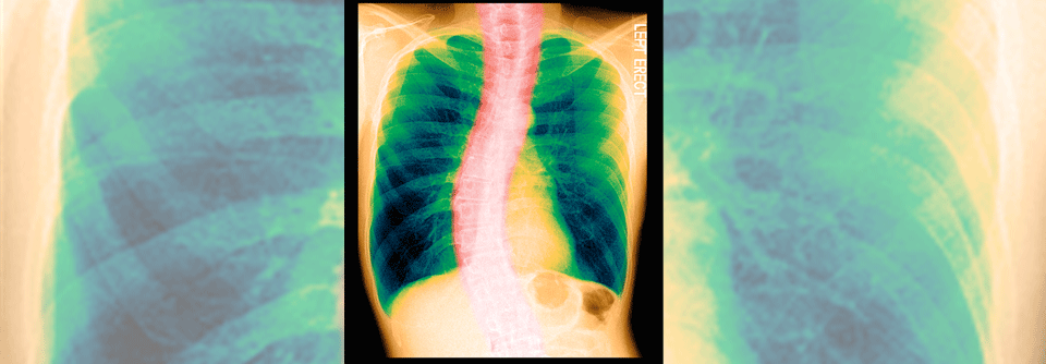 Dieser Patient ist Raucher und er leidet an einer COPD. Für seine verringerte Lungenfunktion ist aber auch die Skoliose verantwortlich, was bei vermeintlich geringem Therapieansprechen berücksichtigt werden muss.