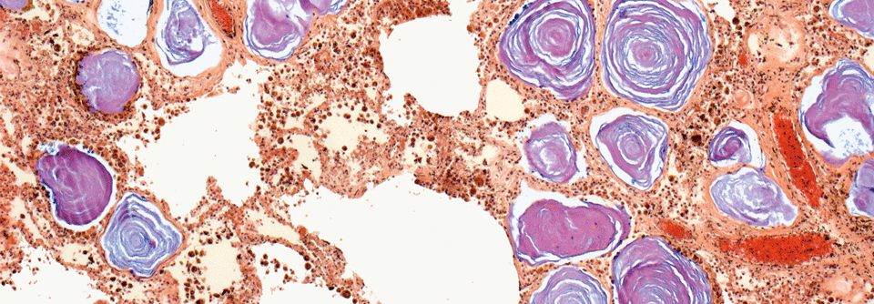 Lungengewebe eines PAM-Patienten unter dem Lichtmikroskop: In den Alveolen stellen sich Kalziumphosphatkristalle (lila) dar.