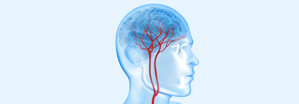 Bei der Riesenzellarteriitis sind vor allem die Arterien im Schläfen- und Halsbereich betroffen.