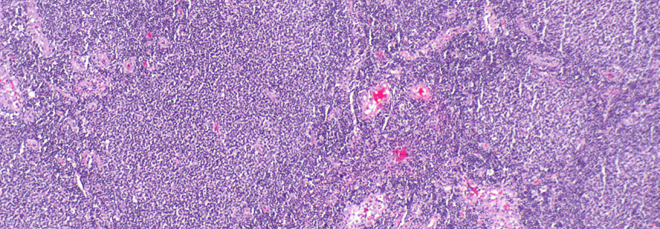 Obinutuzumab zeigt gegenüber Rituximab einige Vorteile bei der Behandlung des follikulären Lymphoms.