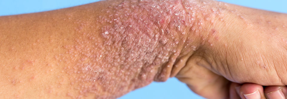 Es hat sich einiges getan in der Therapie der atopischen Dermatitis.