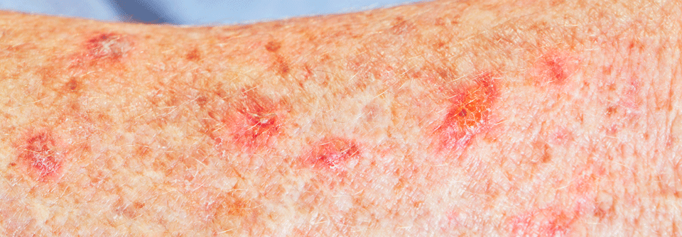 Leicht kann aus einer aktinischen Keratose heller Hautkrebs werden.