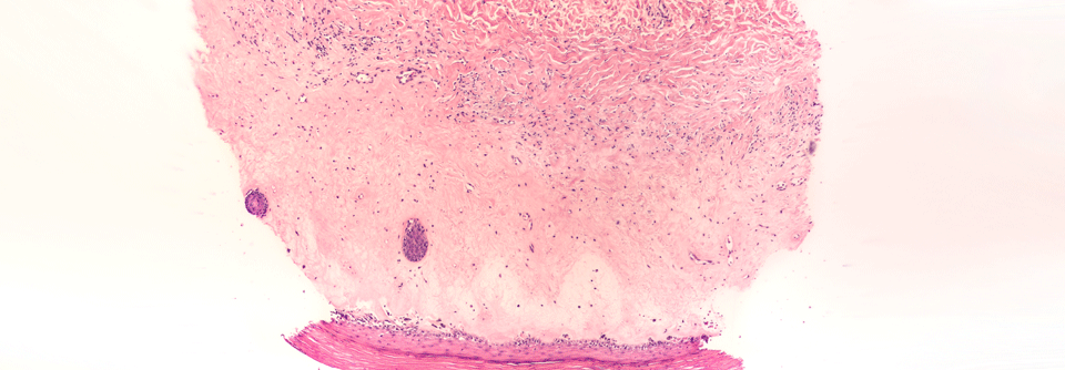 Der Lichen sclerosus äußert sich über Jucken und Schmerzen.