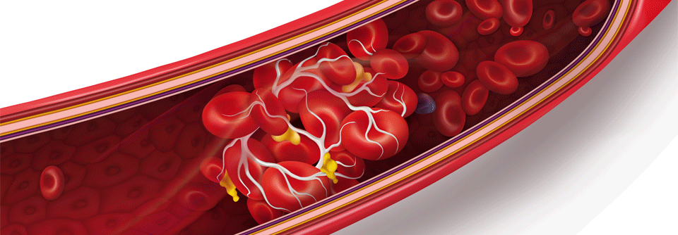 Thrombosen sind eine zusätzliche Gefahr für Krebspatienten.