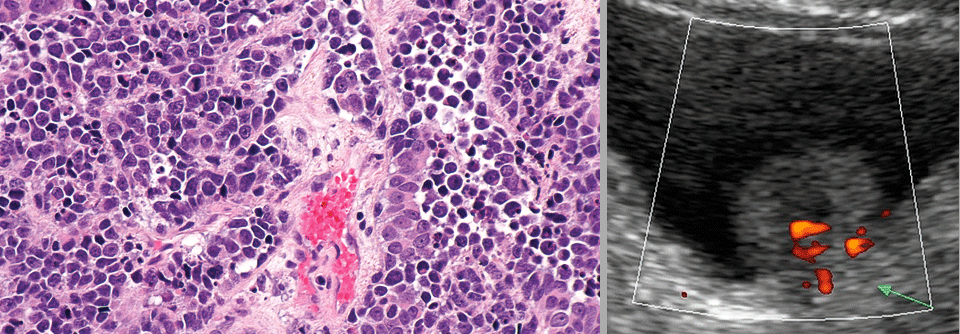 Kleinzelliges Blasenkarzinom im histologischen Schnitt, HE-Färbung (links). Unten ein Harnblasentumor im Ultraschall.