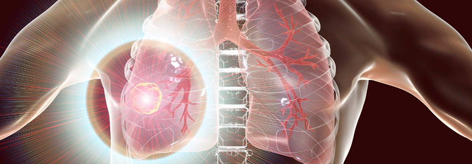 Das NSCLC wird mit vereinten Kräften ins Visier genommen.