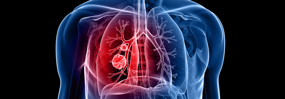 Mittlerweile haben sich einige Wirkstoffe beim mutierten NSCLC bewährt.