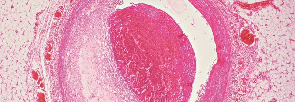 Eine Hypoxie im Rahmen der COPD kann Plaquebildung in den Koronargefäßen begünstigen­.
