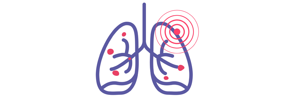 Durch die Zulassung von Selpercatinib steht eine weitere Behandlungsoption gegen NSCLC zur Verfügung.