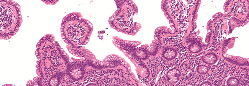 Viel zu kleine monomorphe lymphoide Zellen sind ein histologisches Feature des Mantelzelllymphoms.