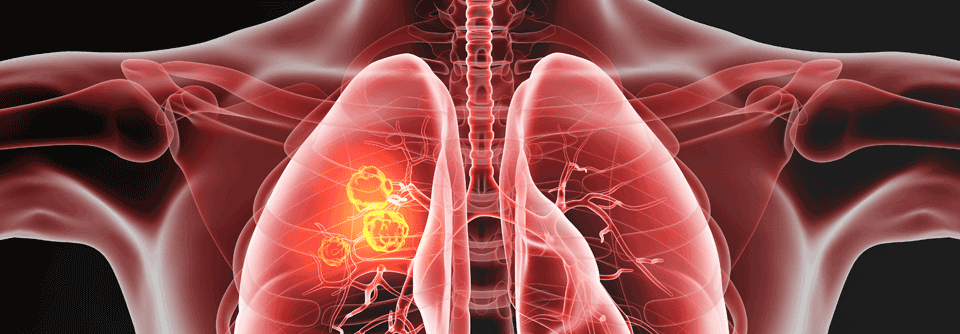 Obwohl es für NSCLC- Mutationen wirksame zielgerichtete Behandlungen gibt, kommt es regelmäßig zu Rezidiven.