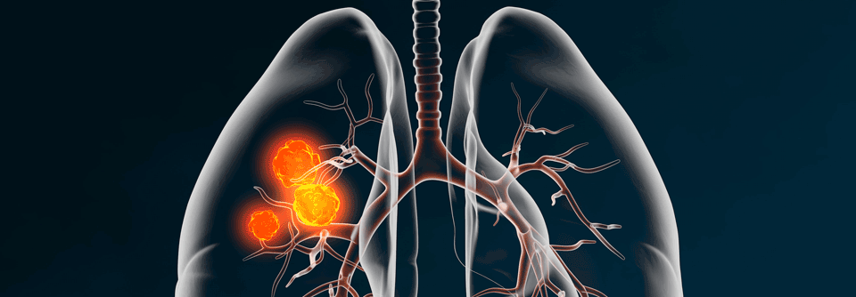 Die NADIM2- Studie zeigt, dass die Überlebens­raten von NSCLC Patienten mit einer neodjuvanten Immunchemotherapie deutlich höher sind als nach einer Chemotherapie. 