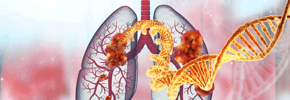 Ca. 50 % der NSCLC-Adenokarzinome weisen Treibermutationen auf. Beim Plattenepithelkarzinom beträgt die Rate nur 5- 10 %. 
