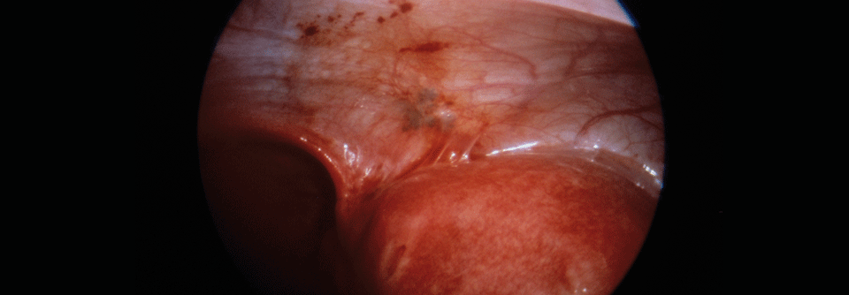 In der Laparoskopie zeigen sich an der Innenwand des Peritoneums dunkle Flecken, die Endometrioseherden entsprechen.