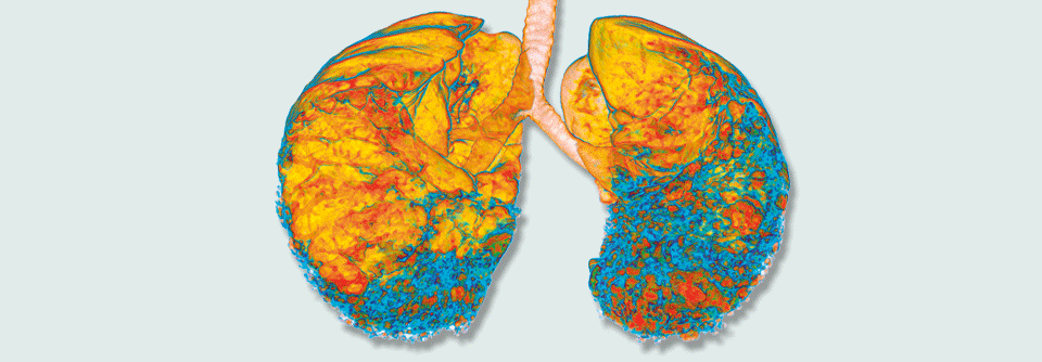 Entwickelt ein Patient eine interstitielle Lungenerkrankung wie hier im 3D-CT erkennbar, sollte man seine Verwandten ersten Grades auf Lungenveränderungen screenen.