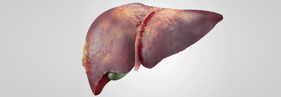 Auch die Entstehung eines hepatozellulären Karzinoms wird durch das metabolische Syndrom begünstigt.