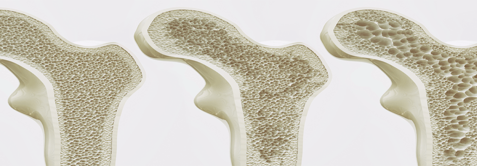 Innerhalb der zehnjährigen Nachbeobachtungszeit entwickelten mit einem Anteil von 6,4 % versus 5,1 % signifikant mehr Fettleberkranke eine Osteoporose als Probanden ohne hepatische Störung. 