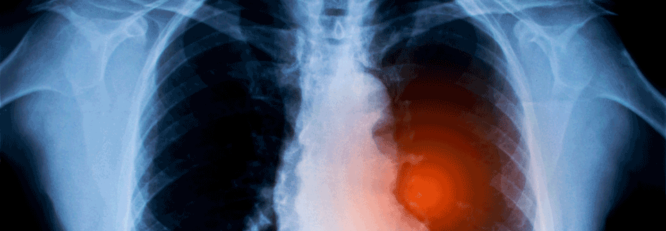 Unausweichlich entwickeln NSCLC-Patient:innen  Resistenzen gegen Tyrosinkinase-Inhibitoren.