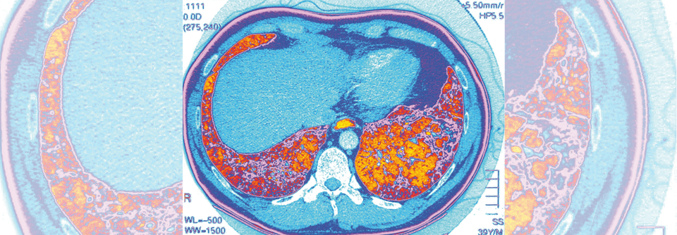 Entzündungsprozesse und Vernarbungen führen bei idiopathischer pulmonaler Fibrose zu respiratorischer Insuffizienz.