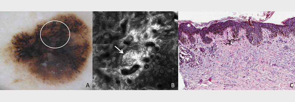 Dermatoskopie-Ansicht (A), RCM-Aufnahme (B) und Histologie (C) eines superfiziell-
spreitenden Melanoms (Breslow-Dicke 0,8 mm). Auf der RCM-Ansicht sind die irregulär geformten Zellcluster gut zu sehen (Pfeil).