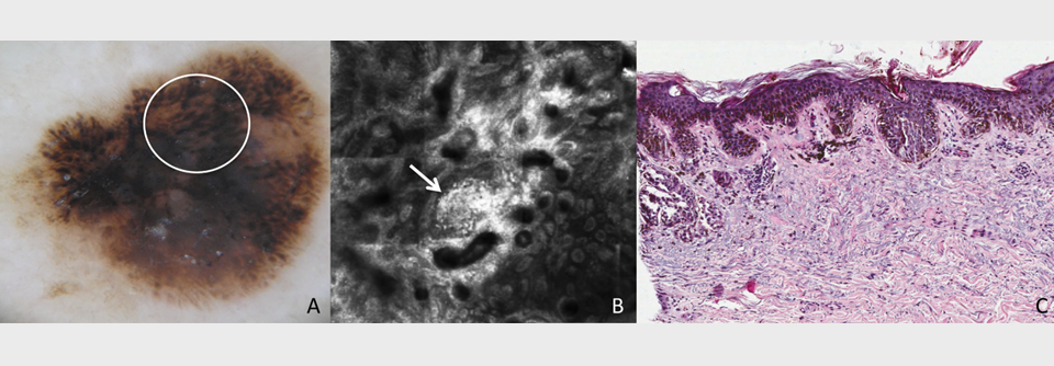 Dermatoskopie-Ansicht (A), RCM-Aufnahme (B) und Histologie (C) eines superfiziell-
spreitenden Melanoms (Breslow-Dicke 0,8 mm). Auf der RCM-Ansicht sind die irregulär geformten Zellcluster gut zu sehen (Pfeil).