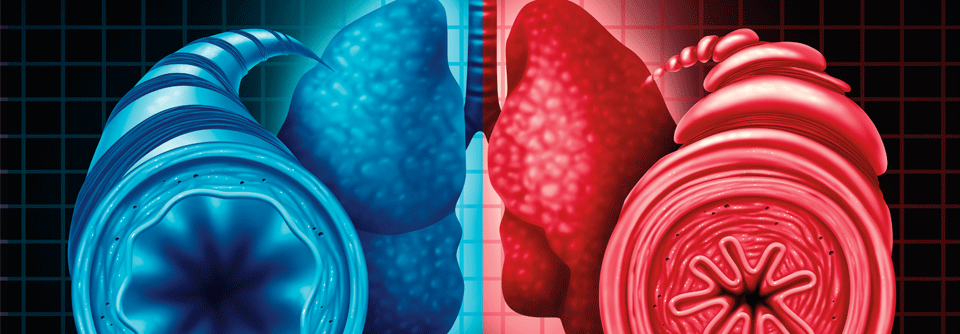 Die chronische Inflammation führt beim schweren Asthma zur anhaltenden Schleimhautschwellung.